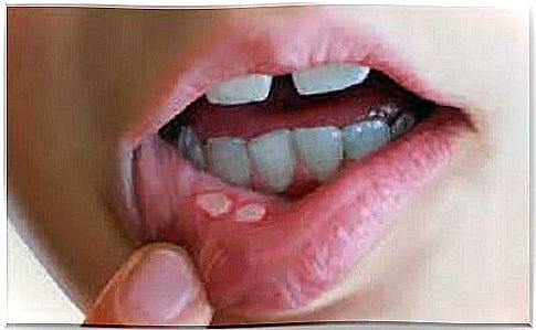 Prevent canker sores