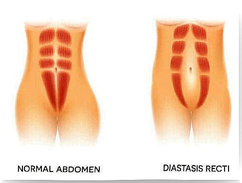 Abdominal diastasis.