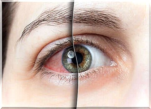 An eye affected by conjunctivitis and a healthy eye