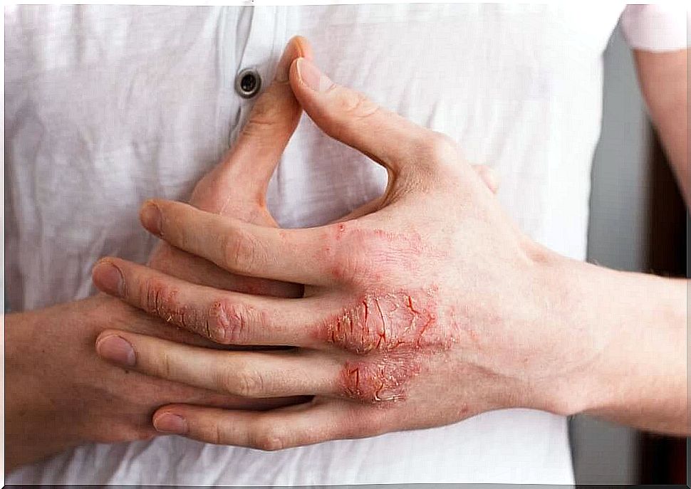 types of eczema