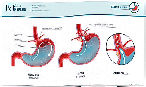 Gastroesophageal reflux disease in the form of patterns