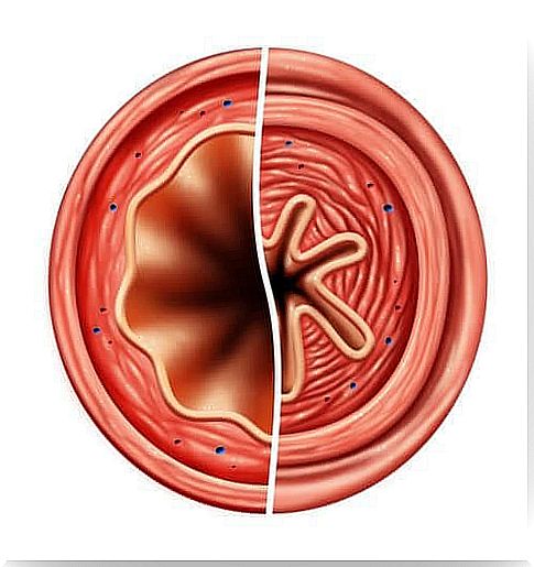 Cutting a diseased trachea to be treated with Terbutaline