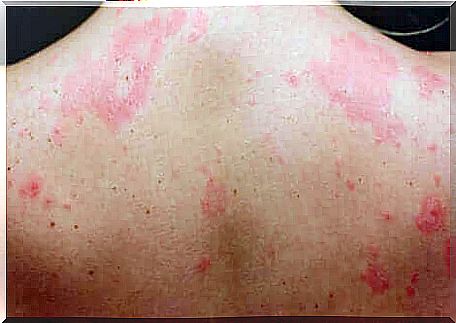 A case of chronic urticaria in the back.