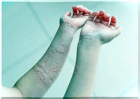 Chronic urticaria on the arms.