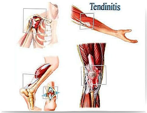 Tendonitis and lesions